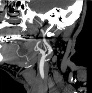 CT  demonstrating Carotid Stenosis